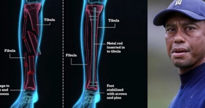 Pročitajte više o članku Prikaz noge Tigera Woodsa ne sluti na dobro, hirurg ne može tvrditi da će opet moći igrati golf