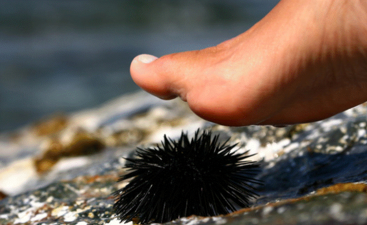 Pročitajte više o članku Kako najlakše ukloniti bodlje ako stanete na morskog ježa?