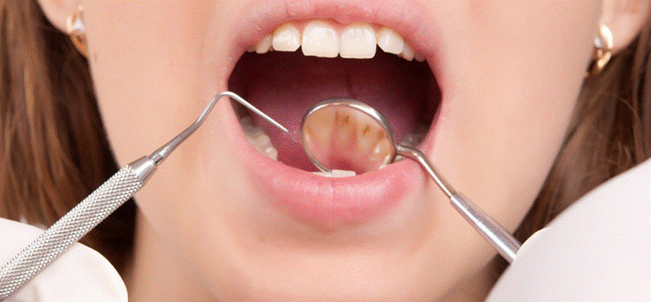 Pročitajte više o članku Riješite se kamenca na zubima prirodnim putem: Evo jednog načina!