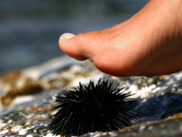 Znate li kako najlakše ukloniti bodlje ako stanete na morskog ježa?