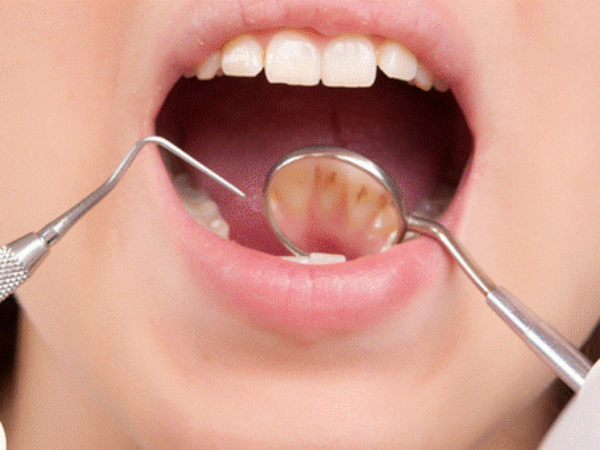 Kamenac ili zubni plak su tvrde naslage na zubima koje su najčešće žućkaste i sive boje