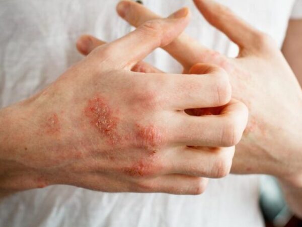 Oni koji su patili od ekcema znaju koliko problemi s kožom mogu biti neugodni. Srećom, postoje koraci pomoću kojih se ovo stanje može ublažiti.
